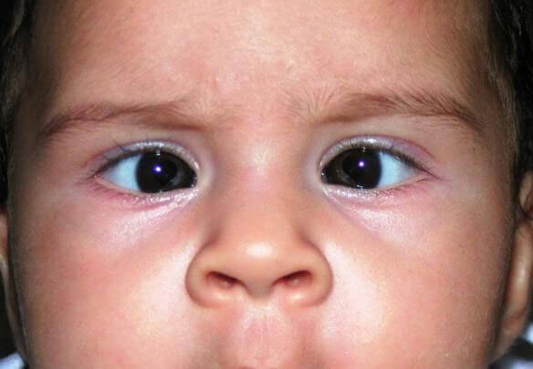 Squint Treatment in children in Nagpur, Maharashtra Ophthalmologist Dr Divya Jain Eye Doctor Nagpur